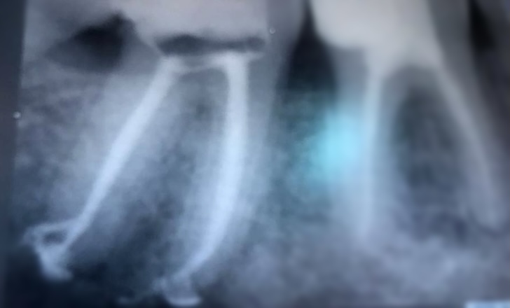 endodonzia